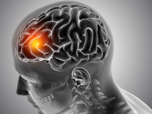 Brain Tumor Will Be Treated In Just 1 Hour