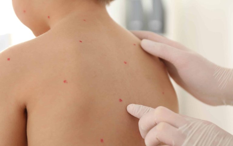 Mumps And Chickenpox | SHRESHTH BHARAT